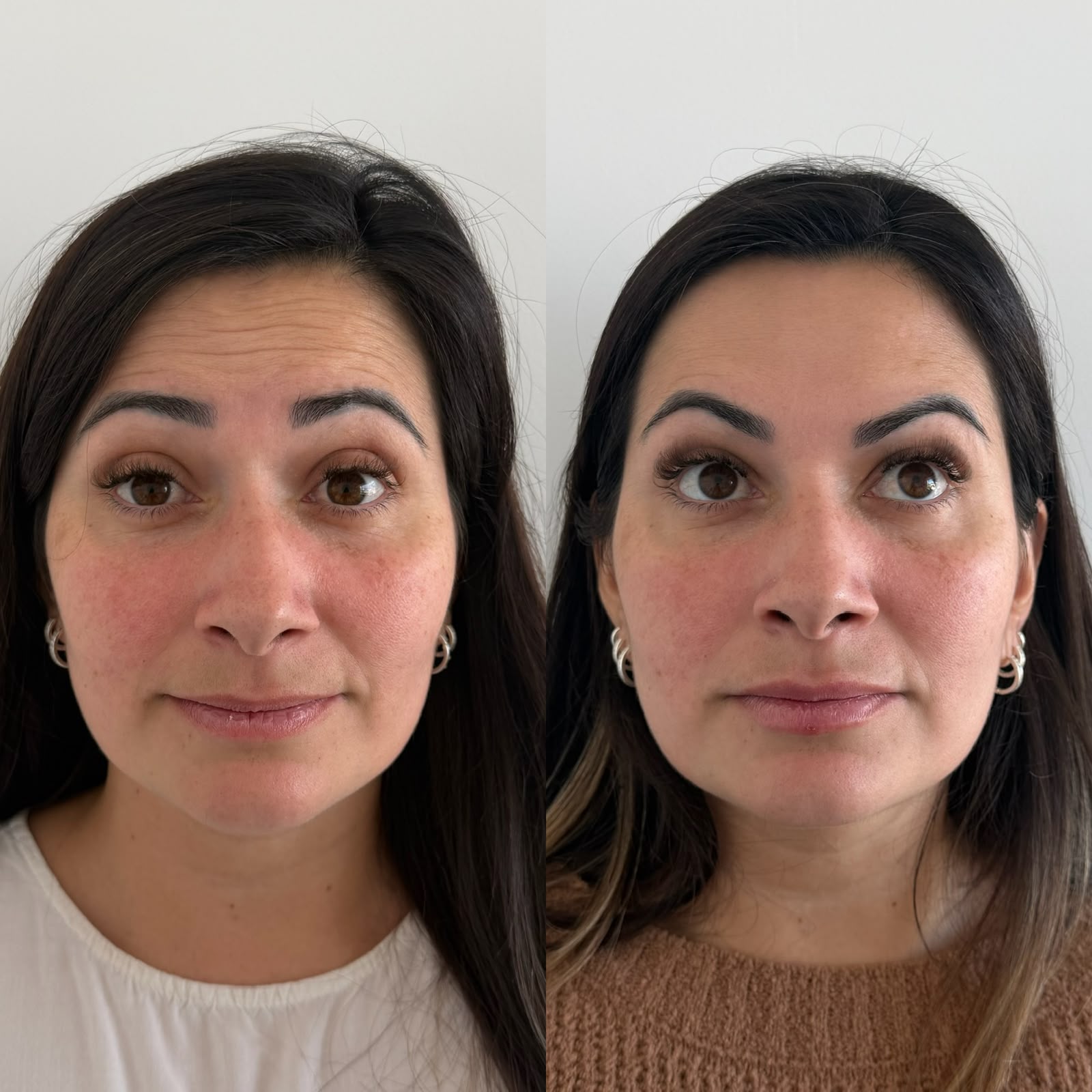 Antes e depois — Harmonização facial