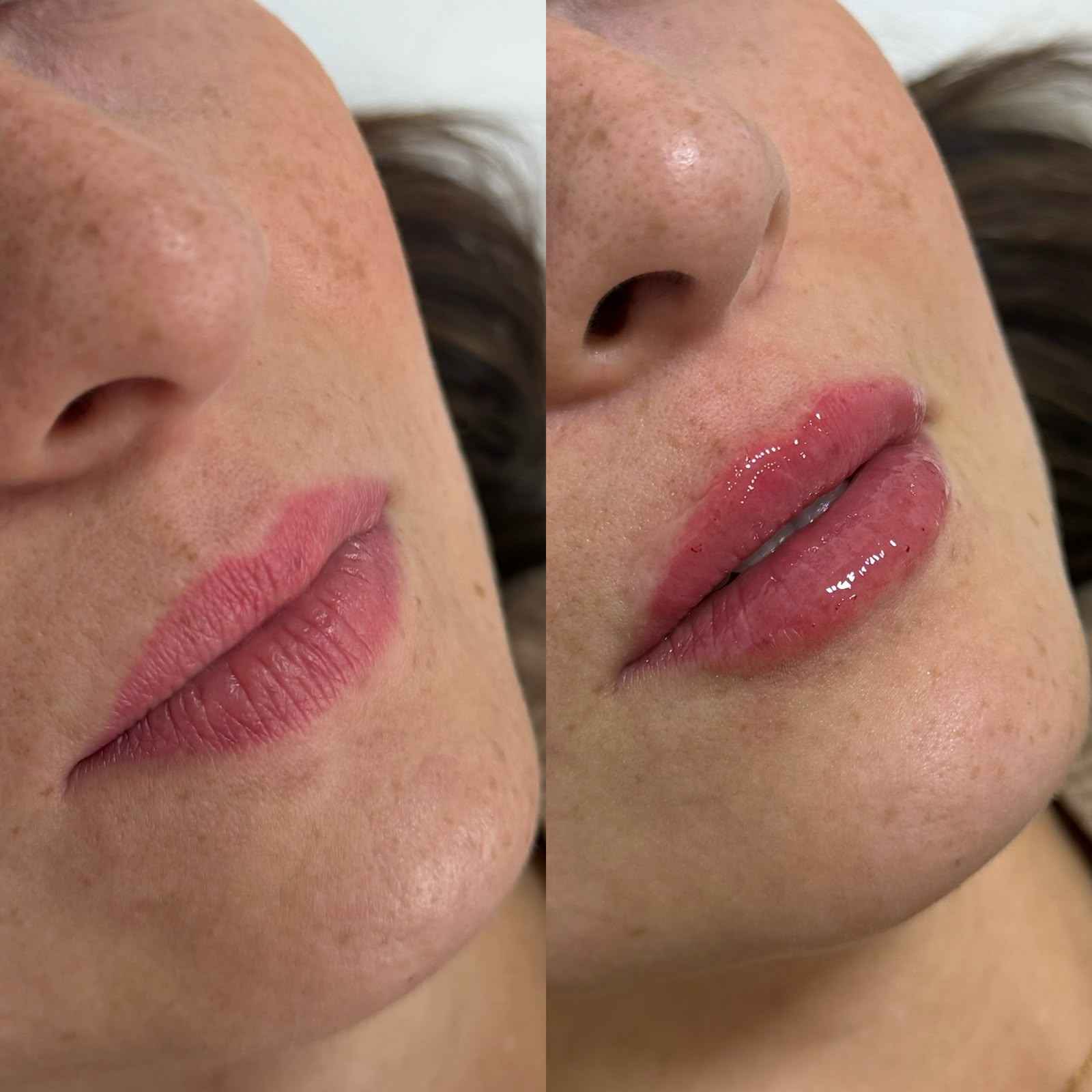 Antes e depois — Preenchimento labial