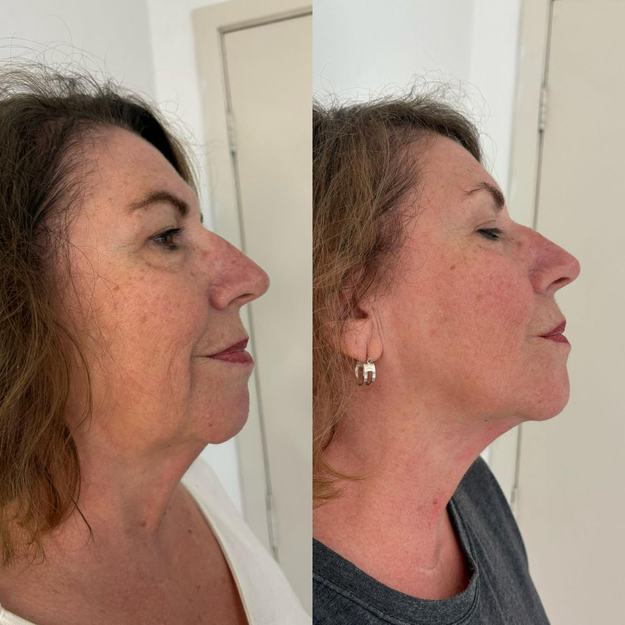 Antes e depois — Contorno & papada