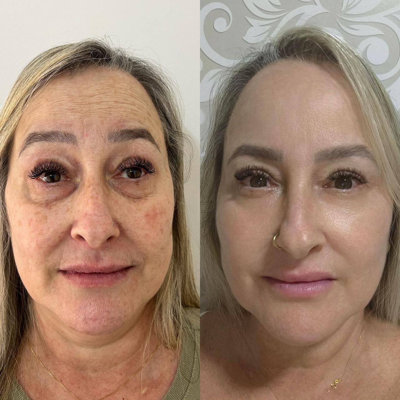Antes e depois — Rejuvenescimento facial