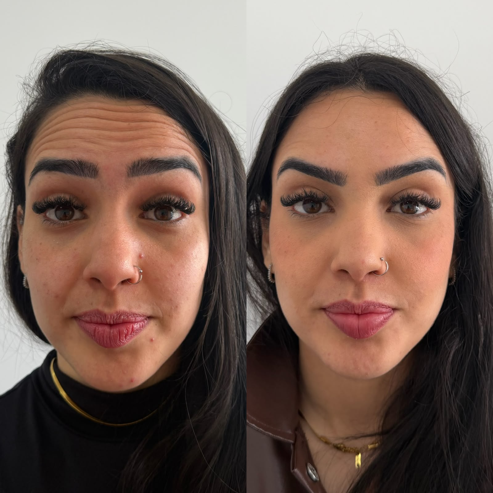 Antes e depois — Botox & rejuvenescimento